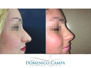 Rinoplastica prima e dopo