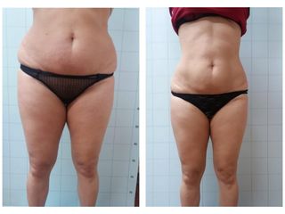Criolipolisi - MEB Medicina estetica e Benessere