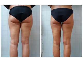 Criolipolisi - MEB Medicina estetica e Benessere