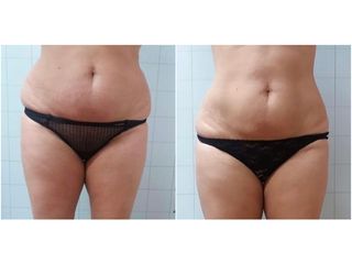 Criolipolisi - MEB Medicina estetica e Benessere