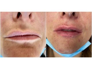 Filler labbra - MEB Medicina estetica e Benessere