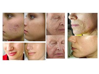 peeling prima dopo