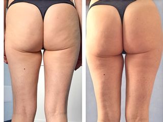 rimodellamento corpo prima e dopo