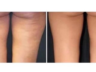 laser prima e dopo