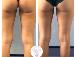 Cellulite prima e dopo