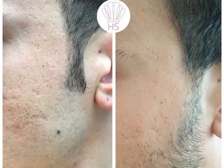 Acne prima e dopo