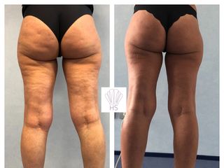 Cellulite prima e dopo