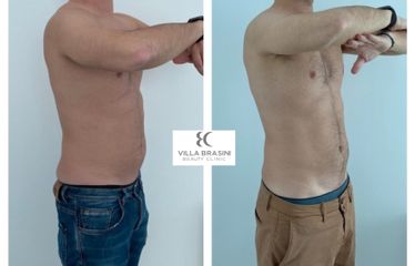 Liposcultura prima e dopo