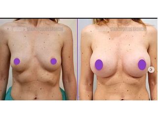 Mastoplastica additiva - Dott.ssa Giuditta Staikopoulos Gronchi