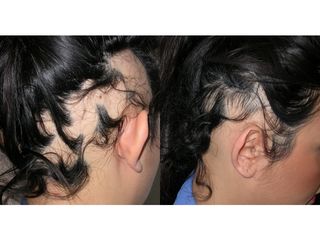 alopecia prima dopo