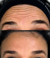 Dott. Gianmarco Urbino Botulino