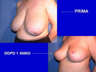 Pre post mastoplastiche aumentative e riduttive