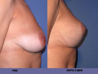 pre post mastoplastiche aumentative e riduttive