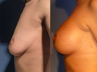 Pre post mastoplastiche aumentative e riduttive