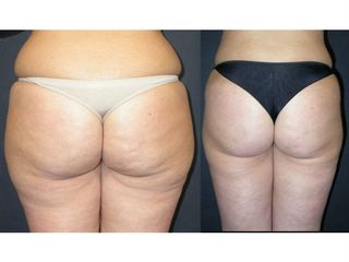 Liposuzione pre post