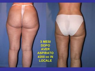 Liposuzione pre post