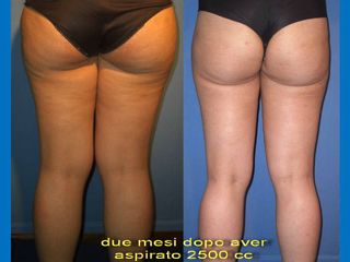 Liposuzione pre post