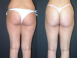 Liposuzione pre post