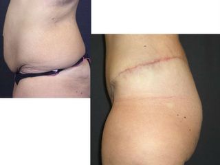 Bodylift pre post