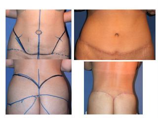 Bodylift pre post