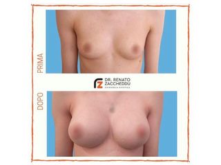 Mastoplastica additiva prima e dopo