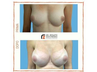 Mastoplastica additiva prima e dopo