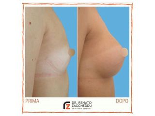 Mastoplastica additiva prima e dopo