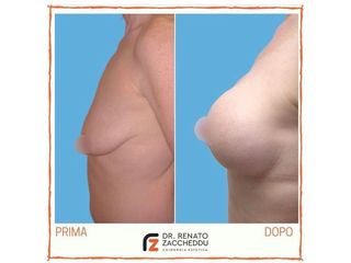 Mastoplastica additiva prima e dopo