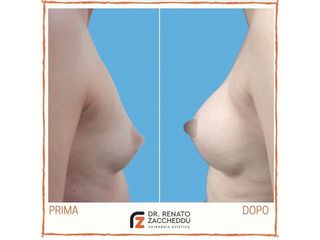 Mastoplastica additiva prima e dopo