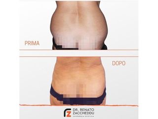 Liposuzione prima e dopo