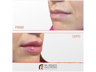 Filler labbra prima e dopo