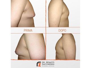 Ginecomastia prima e dopo