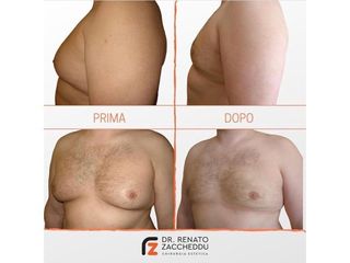 Ginecomastia prima e dopo