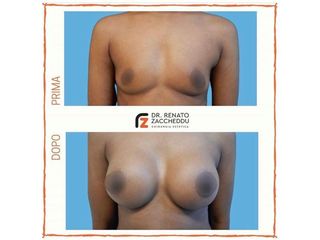 Mastoplastica additiva prima e dopo