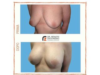 Mastoplastica additiva prima e dopo