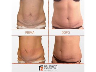 Addominoplastica prima e dopo