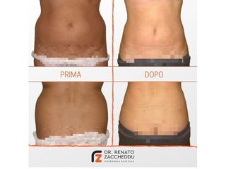 Liposuzione prima e dopo