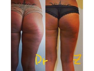 Liposuzione prima e dopo