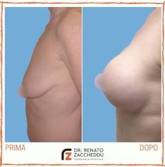 Mastopessi - Dott. Renato Zaccheddu