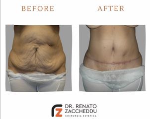 Addominoplastica - Dott. Renato Zaccheddu