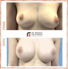 Mastoplastica additiva - Dott. Renato Zaccheddu