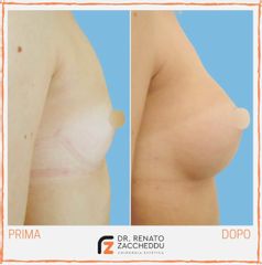 Mastoplastica additiva - Dott. Renato Zaccheddu