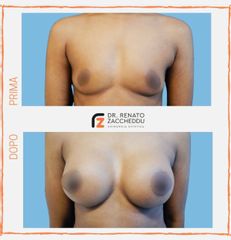 Mastoplastica additiva - Dott. Renato Zaccheddu