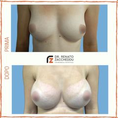 Mastoplastica additiva - Dott. Renato Zaccheddu