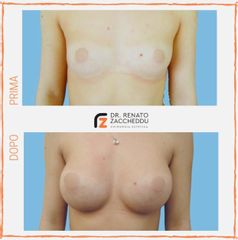 Mastoplastica additiva - Dott. Renato Zaccheddu