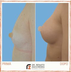 Mastoplastica additiva - Dott. Renato Zaccheddu