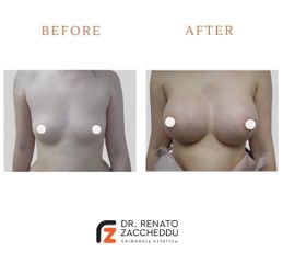 Mastoplastica additiva - Dott. Renato Zaccheddu