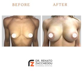 Mastoplastica additiva - Dott. Renato Zaccheddu