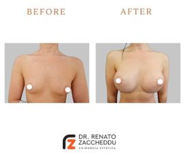 Mastoplastica additiva - Dott. Renato Zaccheddu