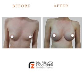 Mastoplastica additiva - Dott. Renato Zaccheddu
